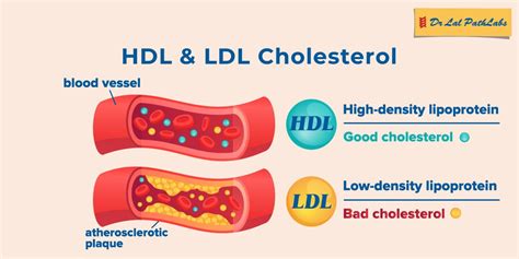 hdklh|High HDL Cholesterol (Hyperalphalipoproteinemia) Treatment.